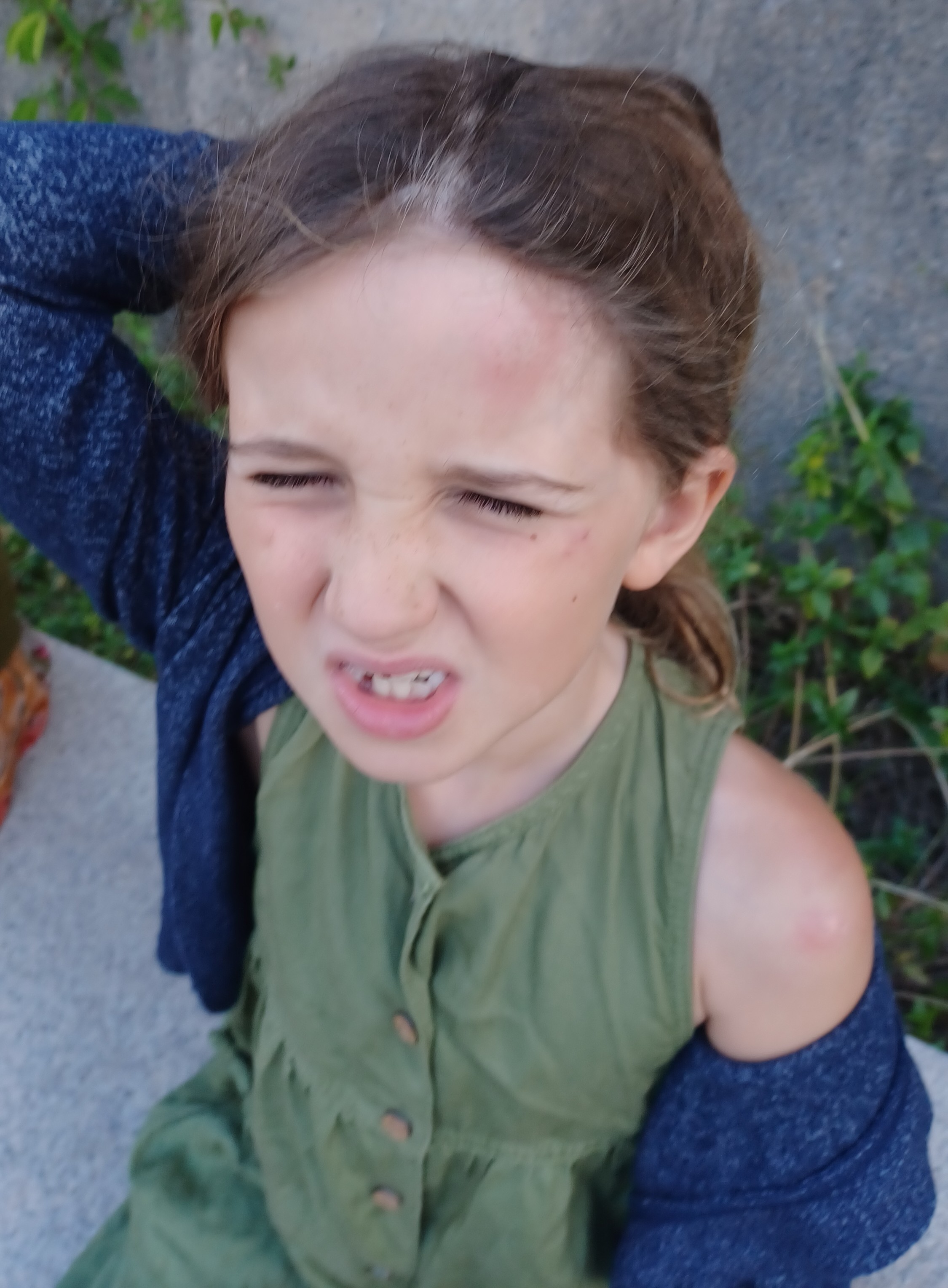 child with bruise on head